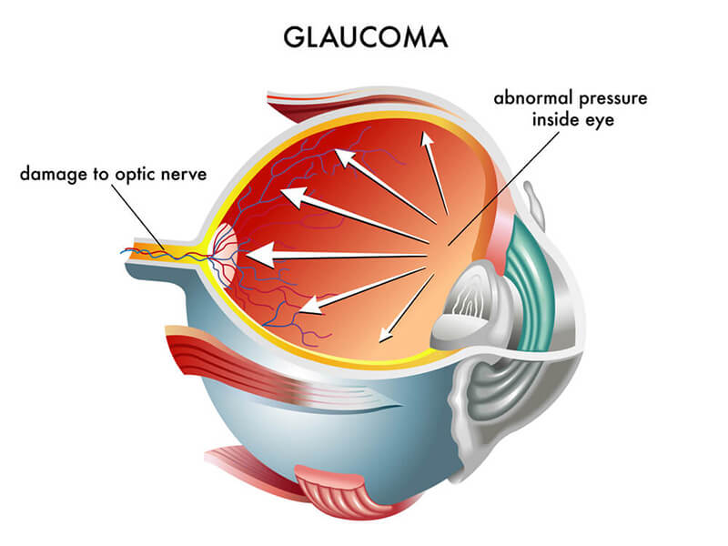 Glaucoma Plymouth NH, Glaucoma Management Gilford