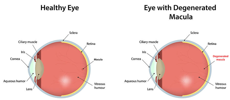 age-related-macular-degeneration-amd-wollongong-eye-doctor